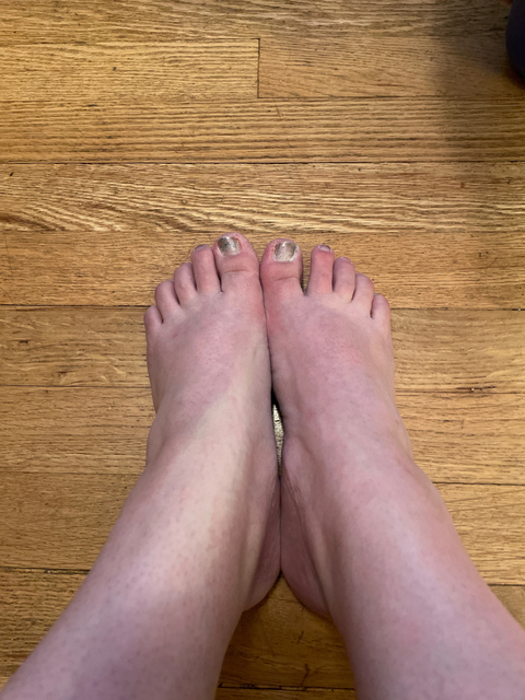 diabeticfeet nude