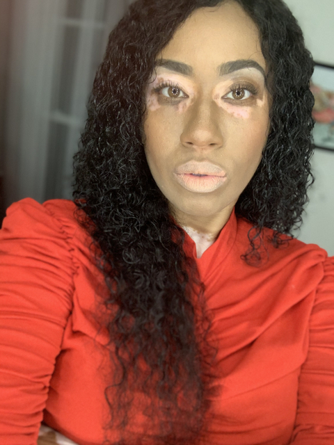 Vitiligo Fox - vitiligofox OnlyFans