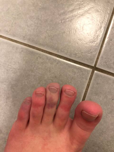 raynaudsfoot