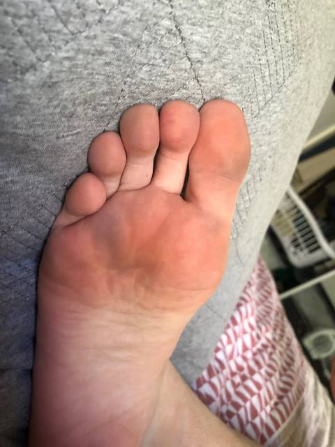 raynaudsfoot nude