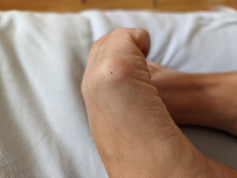 hallux valgus - ugly feet profile picture