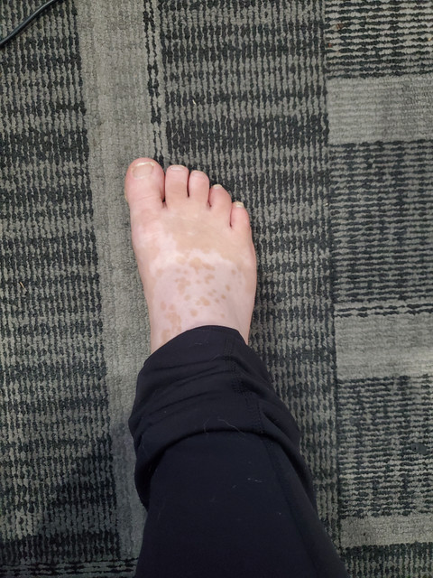 Vitiligo Feet profile picture