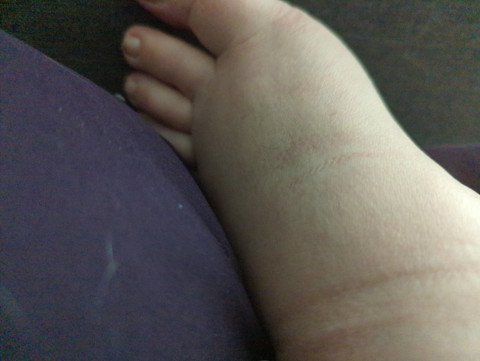 Swollen, fat feet profile picture