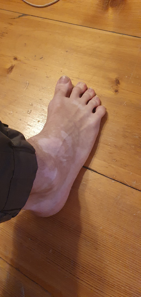 Vitiligo feet guy profile picture